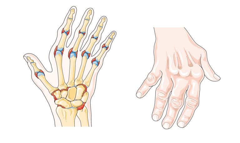 Illustratie die een vergelijking toont tussen een menselijke hand en de botten van een hand. De linkerkant toont een skeletweergave met nadruk op gewrichten, terwijl de rechterkant het uiterlijk van de hand toont met lichte gewrichtsontsteking.
