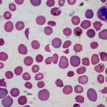 Microscopisch beeld van menselijke bloedcellen met een mix van normale, ronde rode bloedcellen en abnormaal gevormde, puntige echinocyten. De achtergrond is lichtgrijs, wat contrasteert met de roze en paars gekleurde cellen.