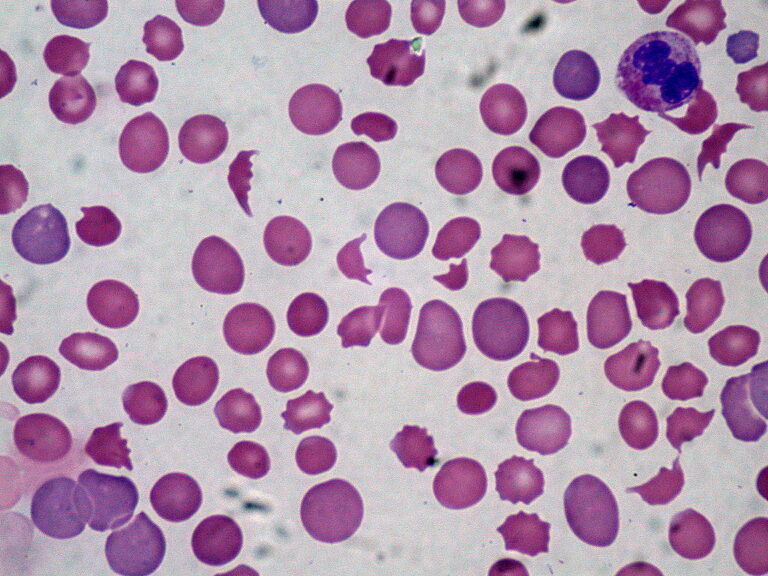Microscopisch beeld van menselijke bloedcellen met een mix van normale, ronde rode bloedcellen en abnormaal gevormde, puntige echinocyten. De achtergrond is lichtgrijs, wat contrasteert met de roze en paars gekleurde cellen.