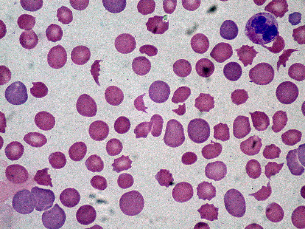 Microscopisch beeld van menselijke bloedcellen met een mix van normale, ronde rode bloedcellen en abnormaal gevormde, puntige echinocyten. De achtergrond is lichtgrijs, wat contrasteert met de roze en paars gekleurde cellen.